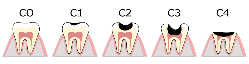 虫歯の段階について