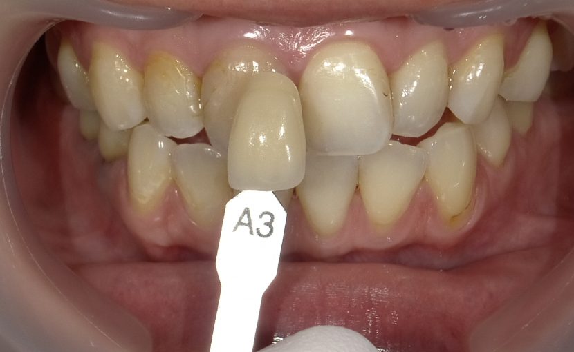 スタッフが実践】加工なし！ホームホワイトニングの効果